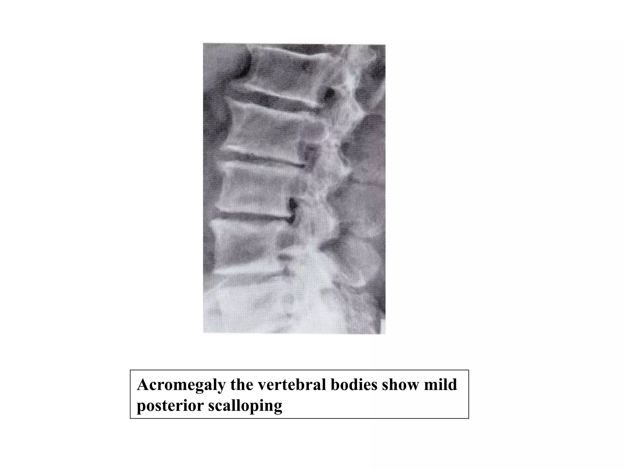 Acromegaly the vertebral bodies show mild
posterior scalloping
 