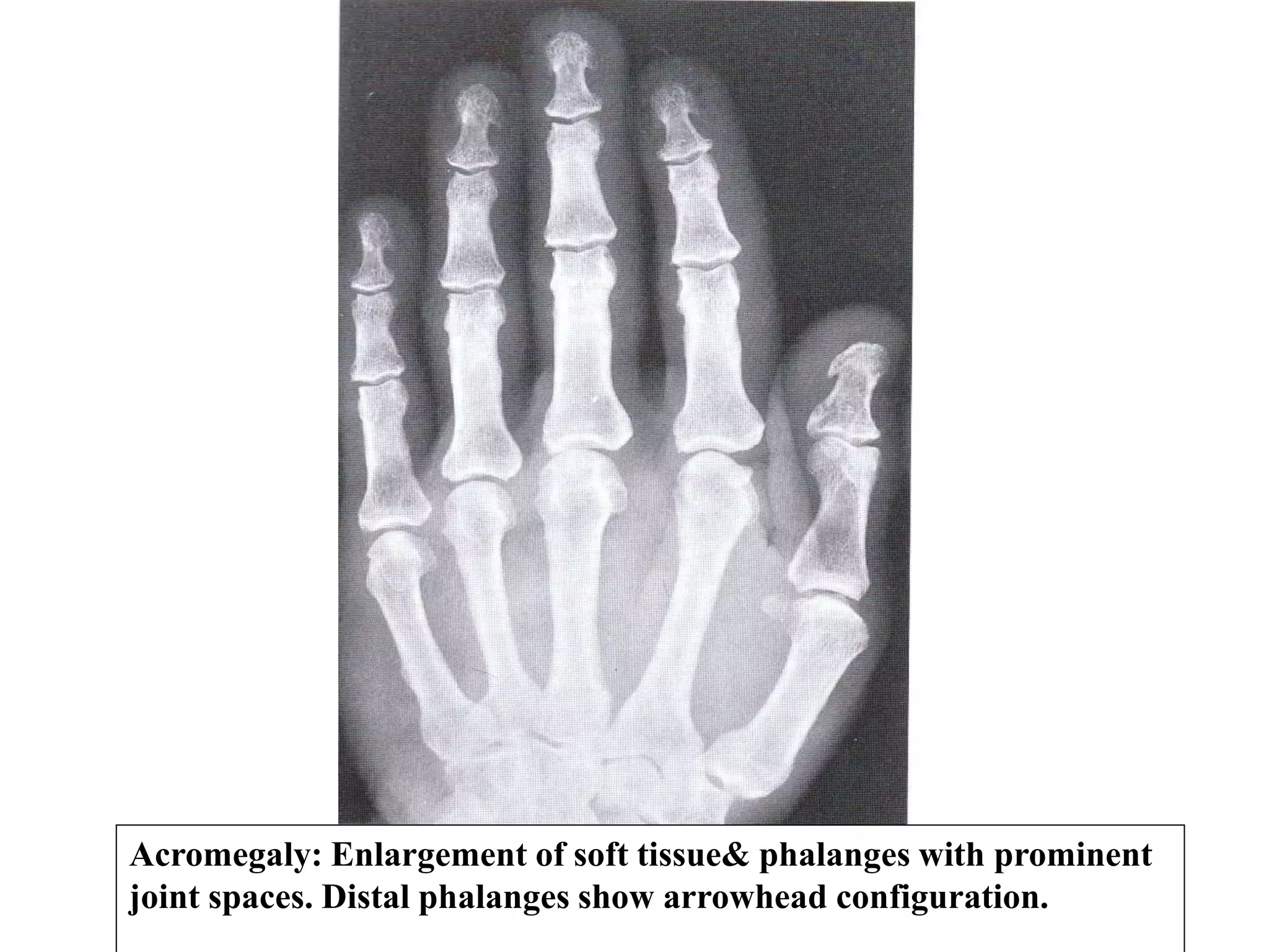 Acromegaly: Enlargement of soft tissue& phalanges with prominent
joint spaces. Distal phalanges show arrowhead configuration.
 