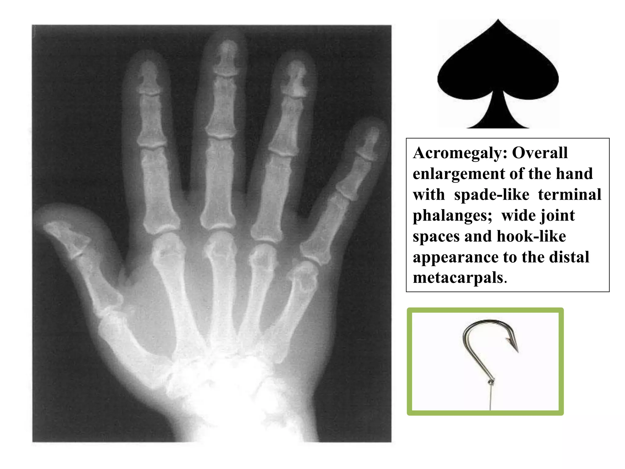 Acromegaly: Overall
enlargement of the hand
with spade-like terminal
phalanges; wide joint
spaces and hook-like
appearance to the distal
metacarpals.
 