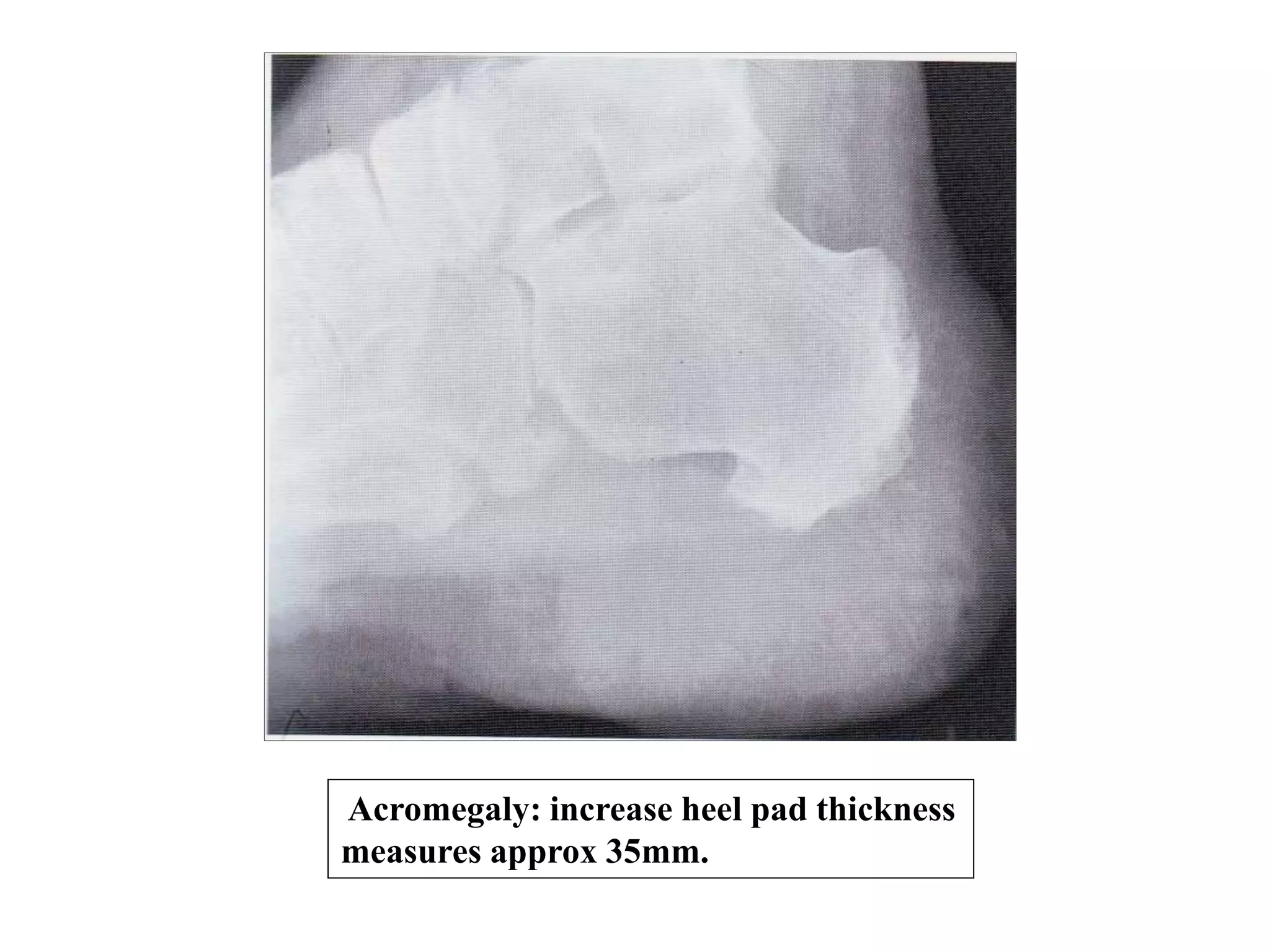 Acromegaly: increase heel pad thickness
measures approx 35mm.
 