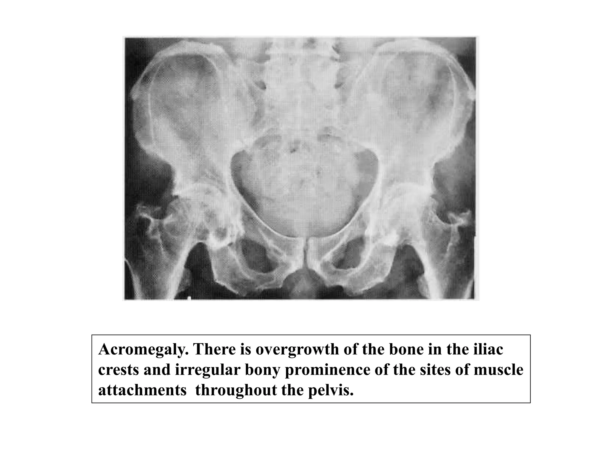 Acromegaly. There is overgrowth of the bone in the iliac
crests and irregular bony prominence of the sites of muscle
attachments throughout the pelvis.
 