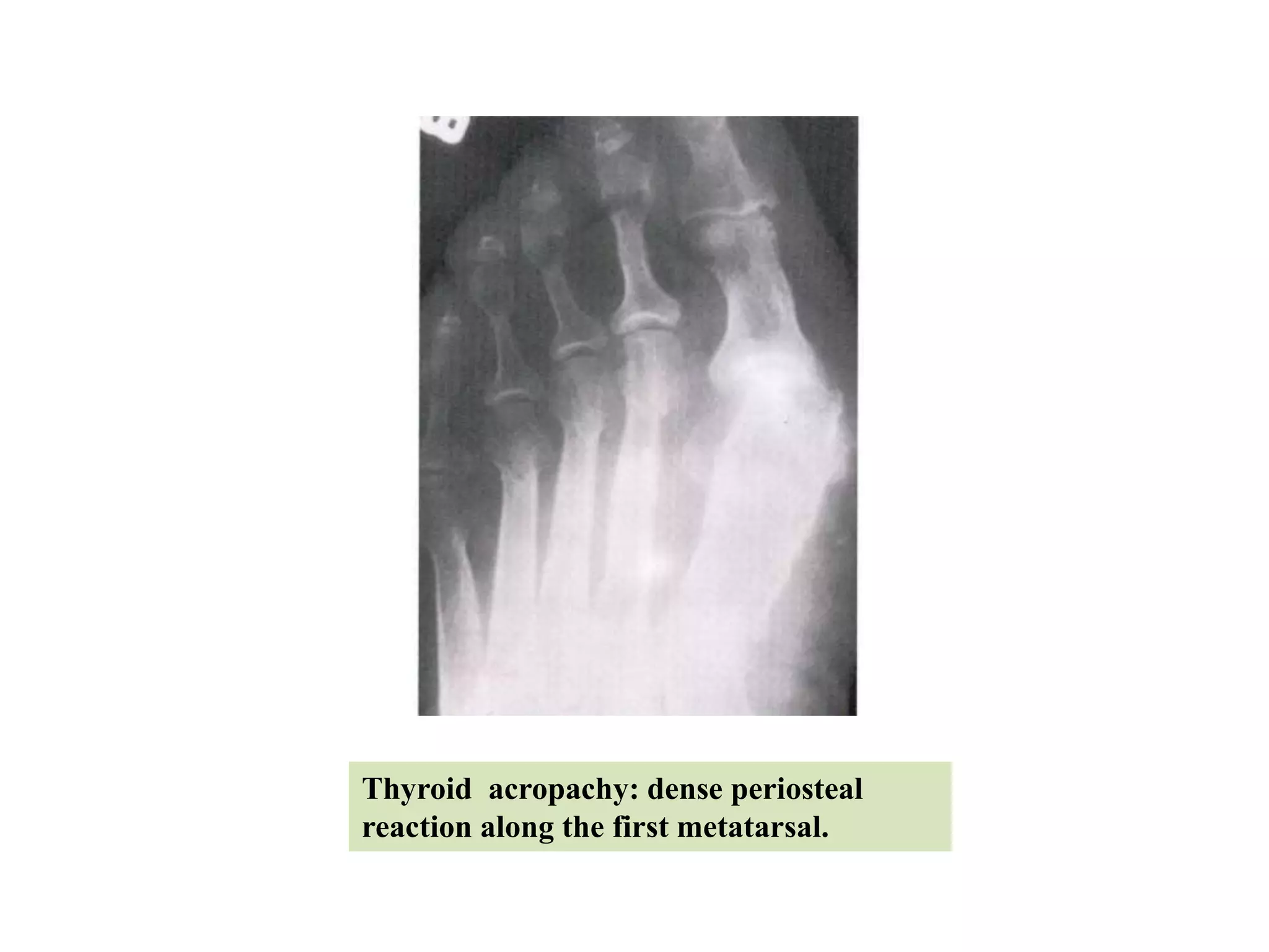 Thyroid acropachy: dense periosteal
reaction along the first metatarsal.
 