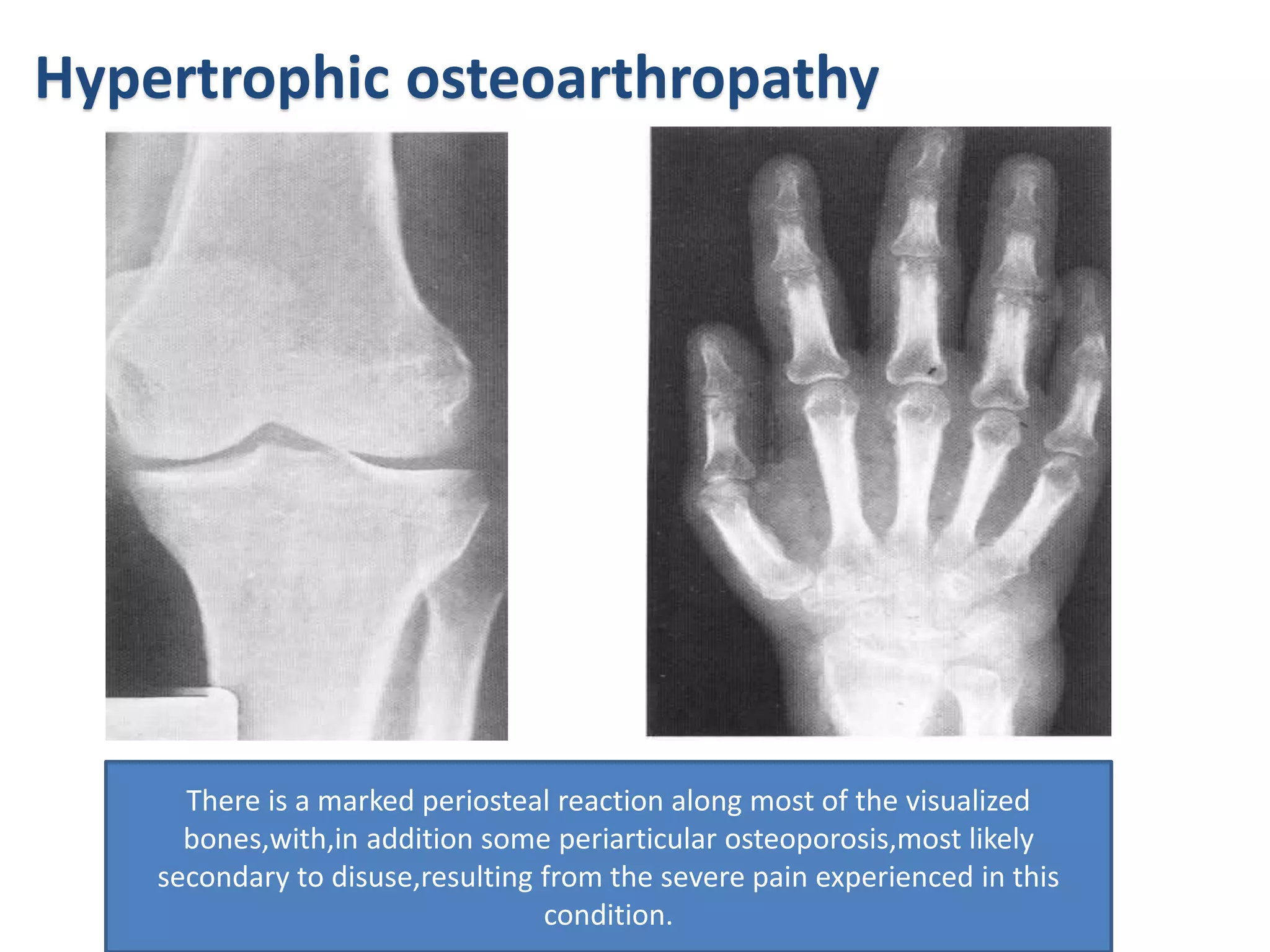 Hypertrophic osteoarthropathy
There is a marked periosteal reaction along most of the visualized
bones,with,in addition some periarticular osteoporosis,most likely
secondary to disuse,resulting from the severe pain experienced in this
condition.
 