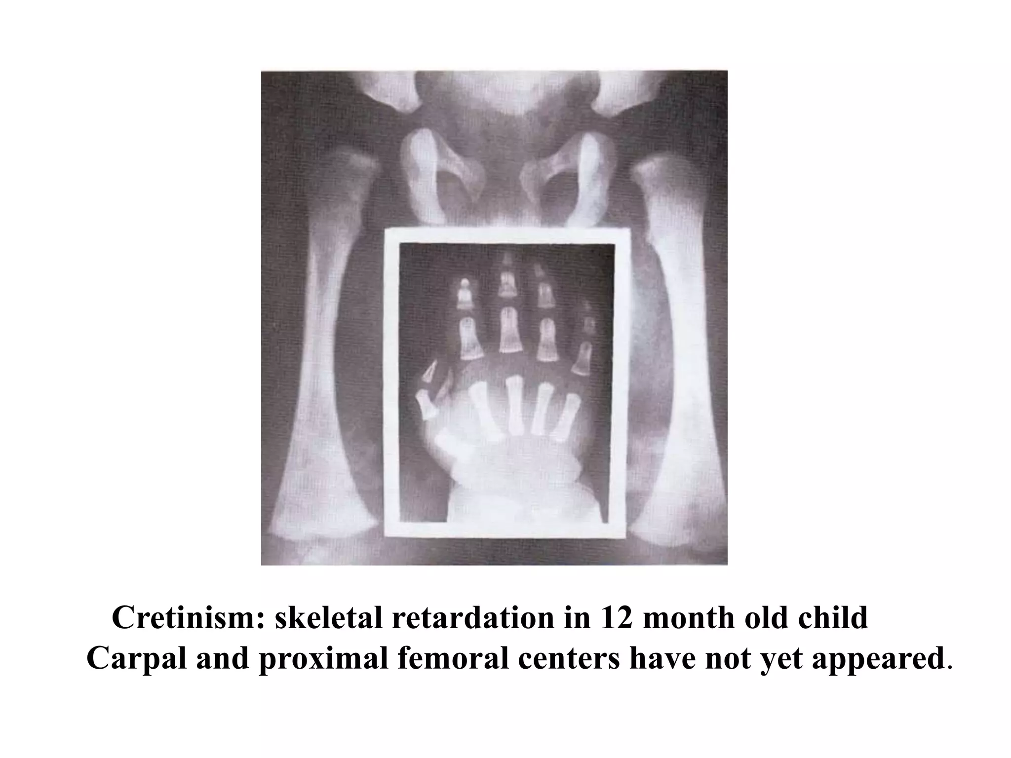 Cretinism: skeletal retardation in 12 month old child
Carpal and proximal femoral centers have not yet appeared.
 
