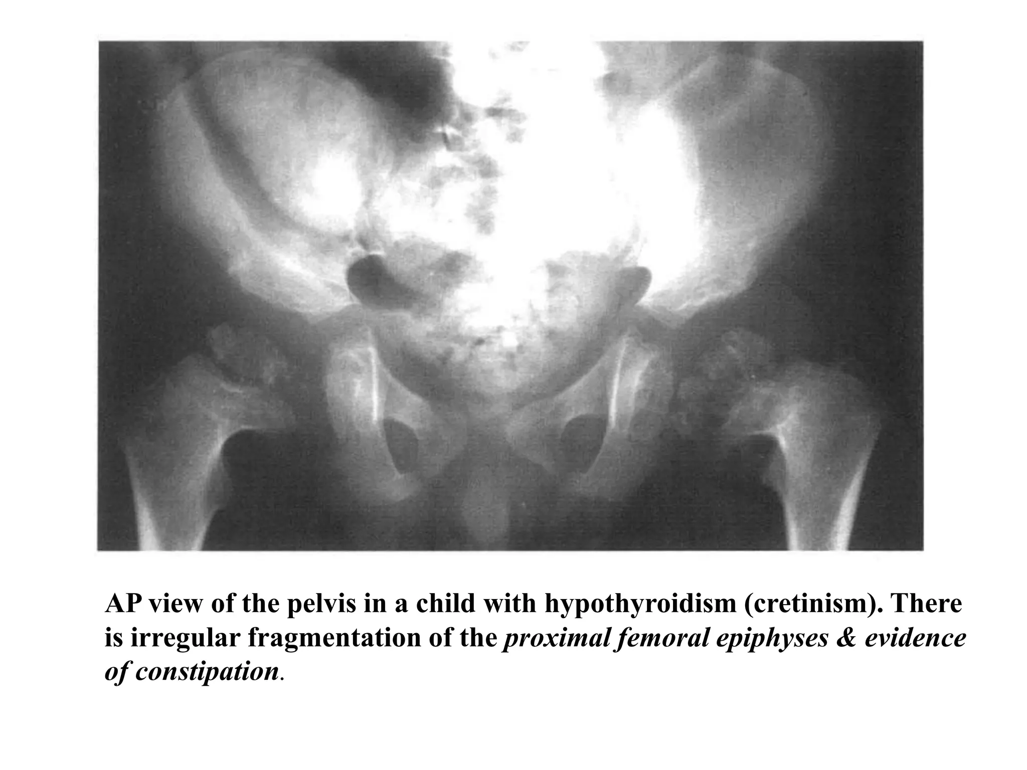 AP view of the pelvis in a child with hypothyroidism (cretinism). There
is irregular fragmentation of the proximal femoral epiphyses & evidence
of constipation.
 