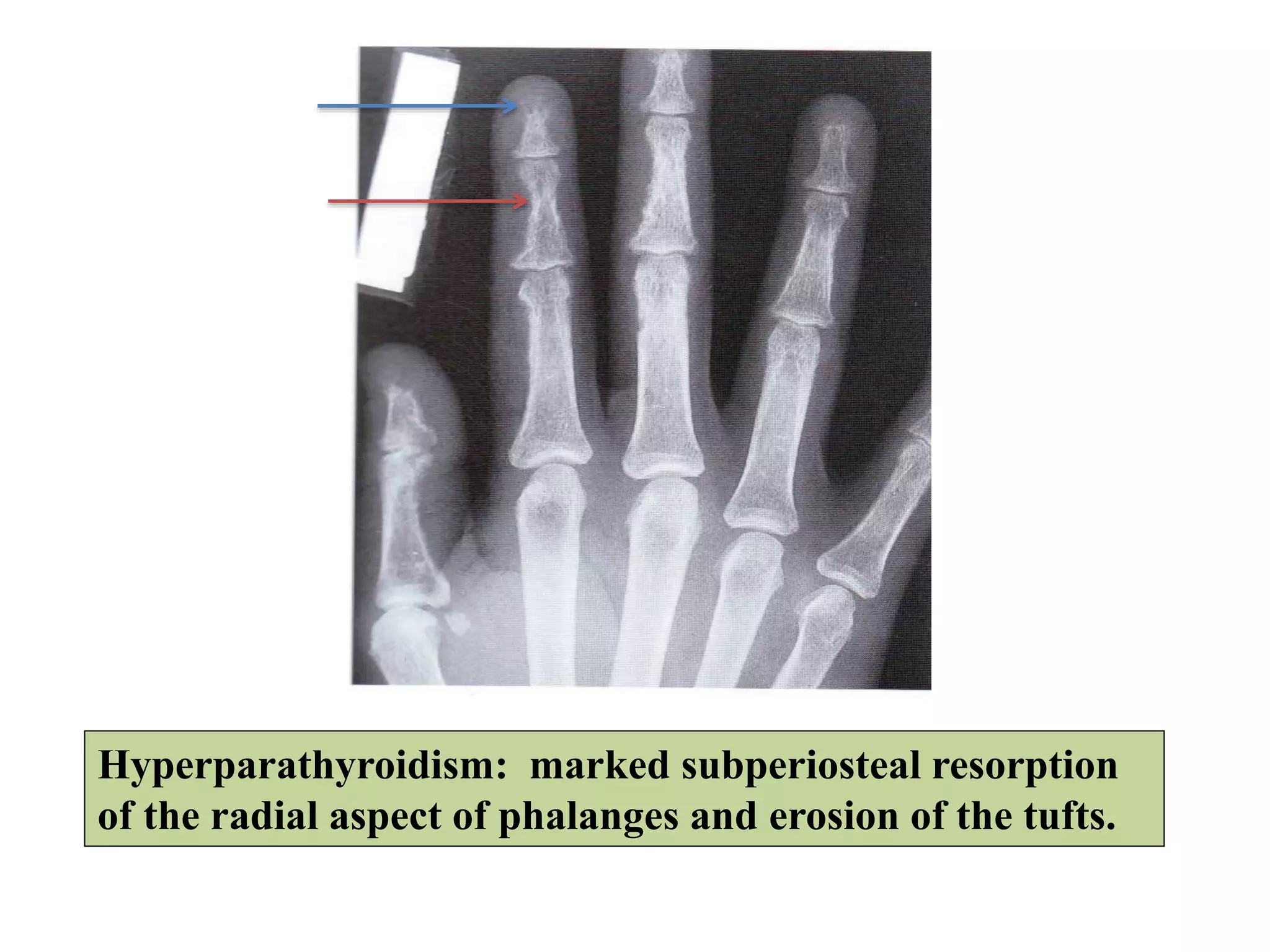 Hyperparathyroidism: marked subperiosteal resorption
of the radial aspect of phalanges and erosion of the tufts.
 