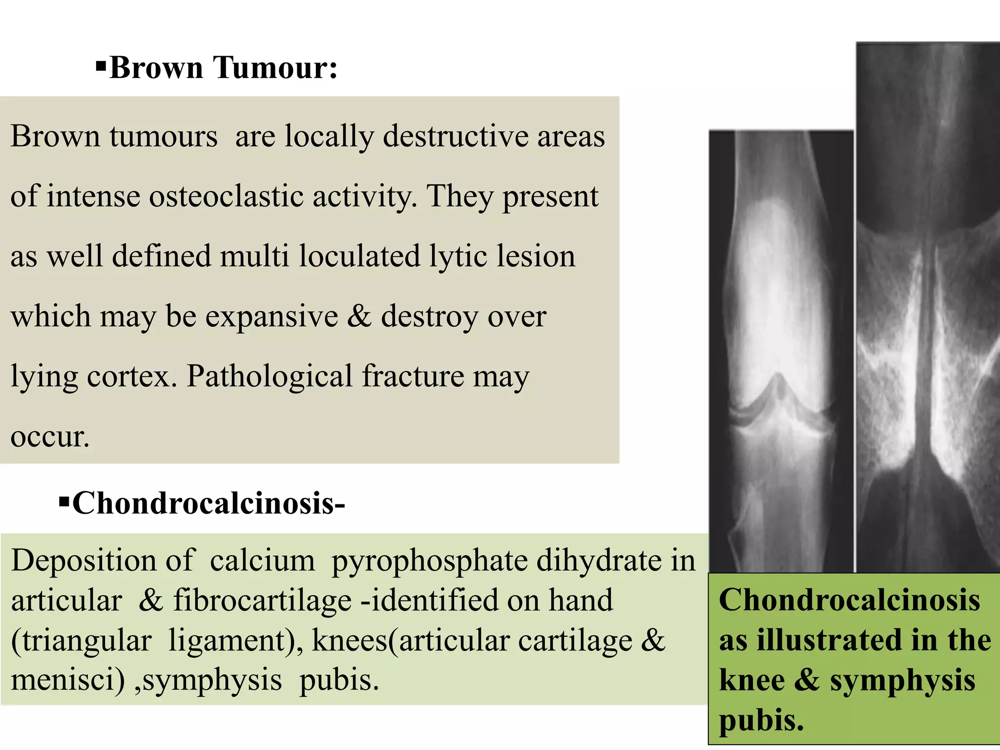 Brown Tumour:
Brown tumours are locally destructive areas
of intense osteoclastic activity. They present
as well defined multi loculated lytic lesion
which may be expansive & destroy over
lying cortex. Pathological fracture may
occur.
Chondrocalcinosis-
Deposition of calcium pyrophosphate dihydrate in
articular & fibrocartilage -identified on hand
(triangular ligament), knees(articular cartilage &
menisci) ,symphysis pubis.
Brown tumour in
tibia
Chondrocalcinosis
as illustrated in the
knee & symphysis
pubis.
 
