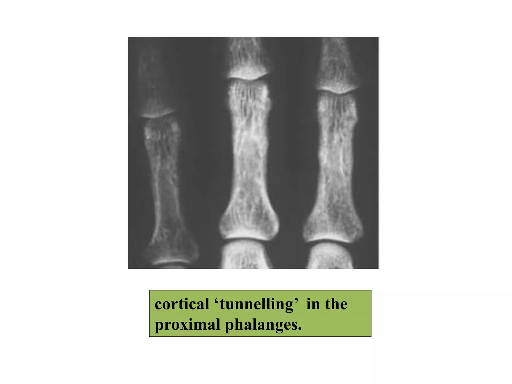cortical ‘tunnelling’ in the
proximal phalanges.
 