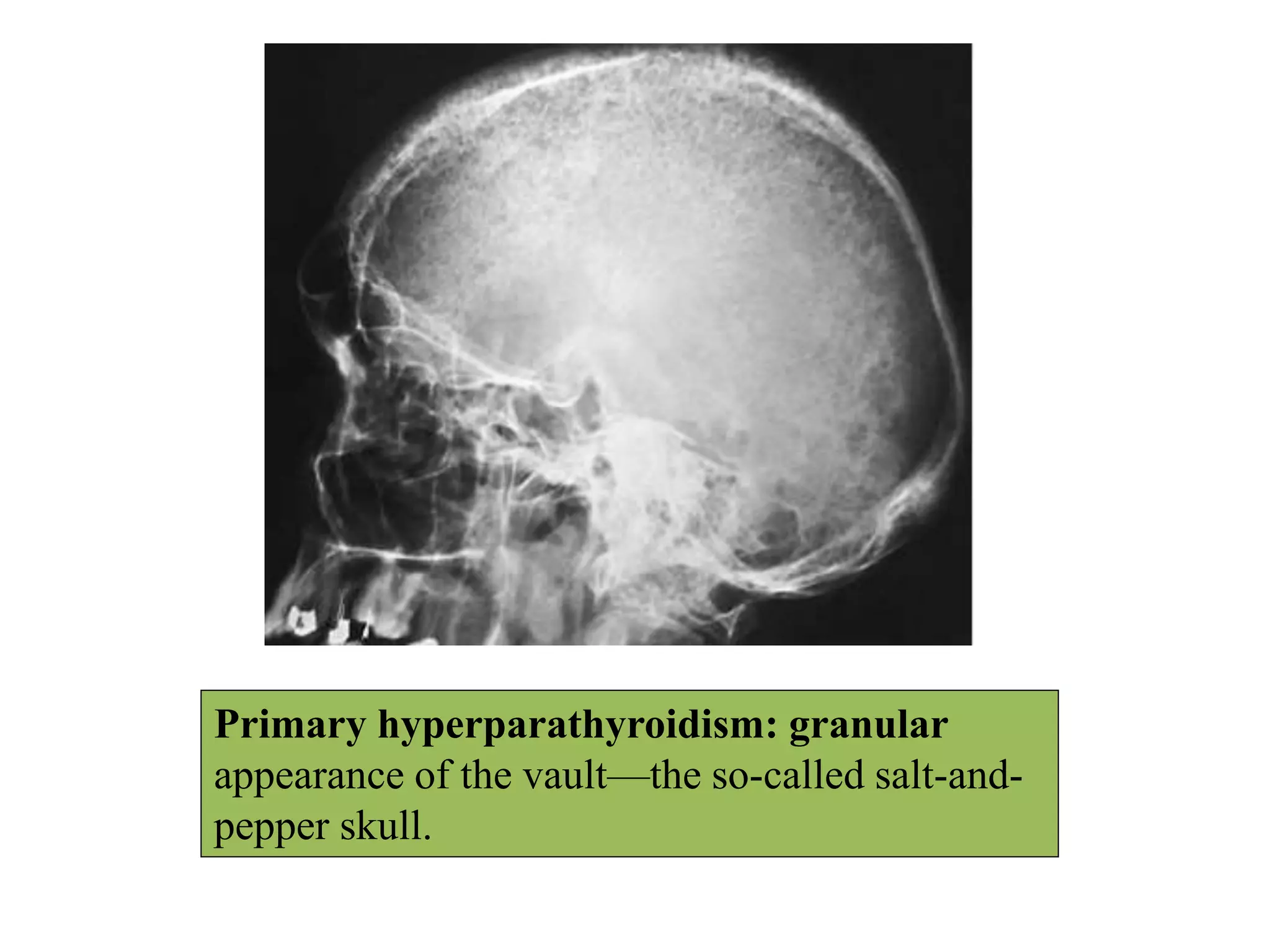 Primary hyperparathyroidism: granular
appearance of the vault—the so-called salt-and-
pepper skull.
 