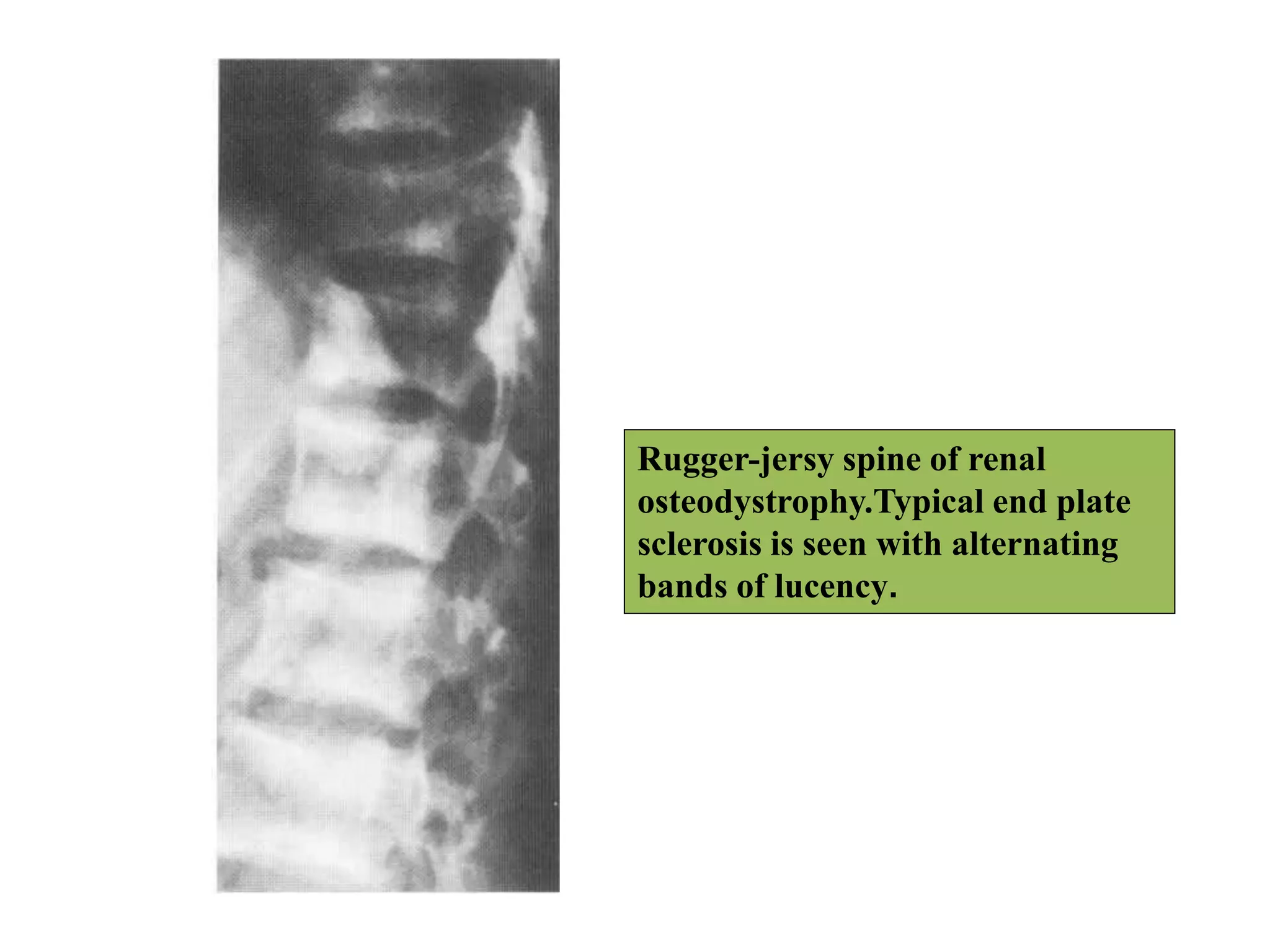 Rugger-jersy spine of renal
osteodystrophy.Typical end plate
sclerosis is seen with alternating
bands of lucency.
 