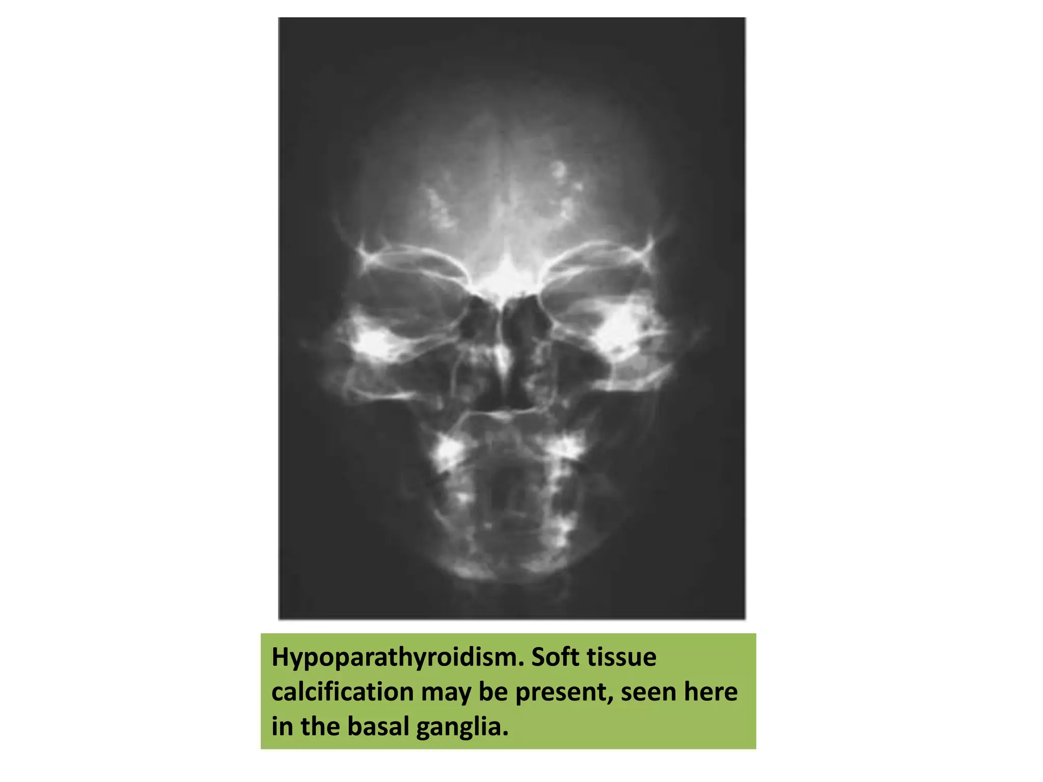 Hypoparathyroidism. Soft tissue
calcification may be present, seen here
in the basal ganglia.
 