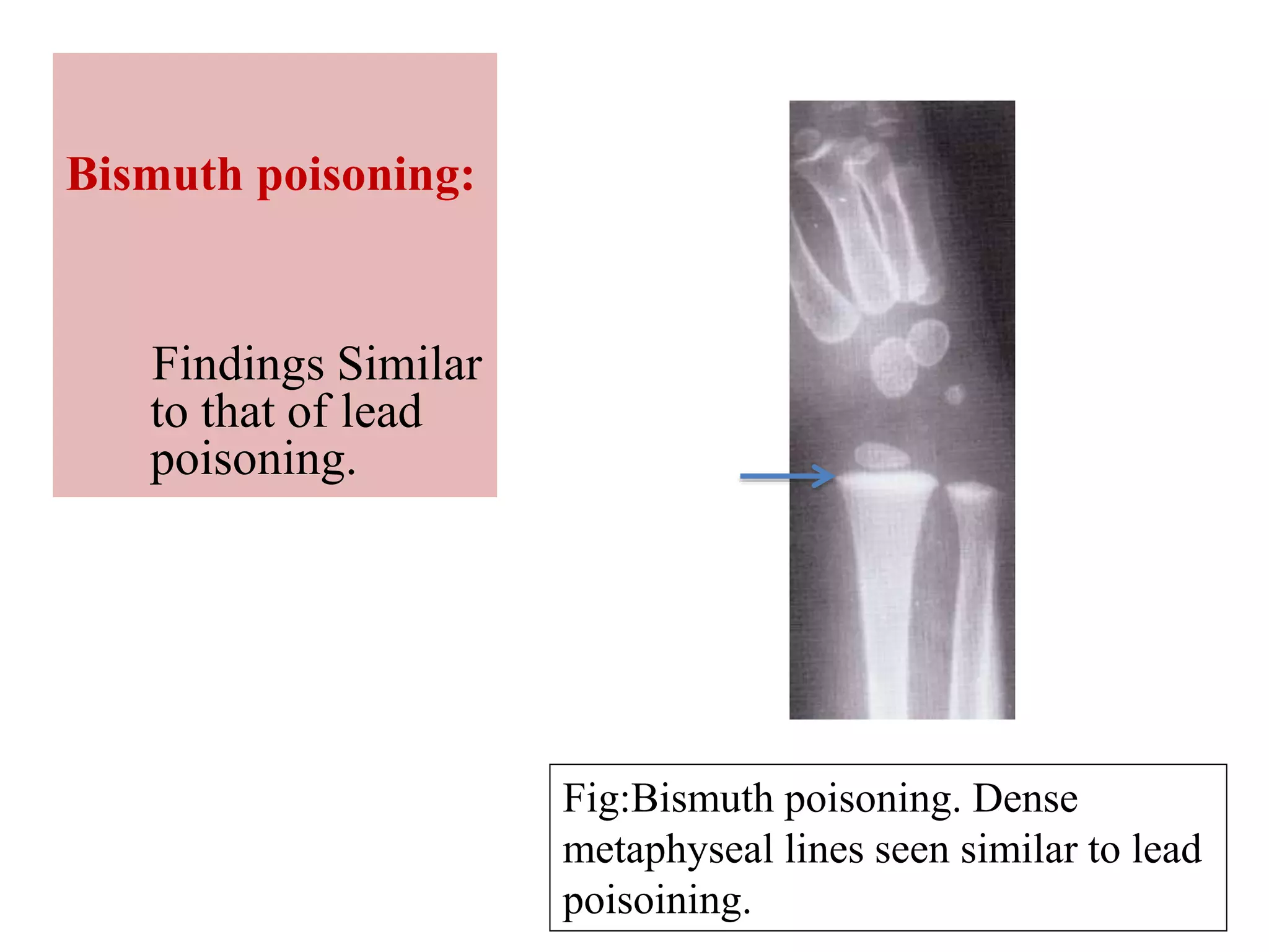 Fig:Bismuth poisoning. Dense
metaphyseal lines seen similar to lead
poisoining.
Bismuth poisoning:
Findings Similar
to that of lead
poisoning.
 