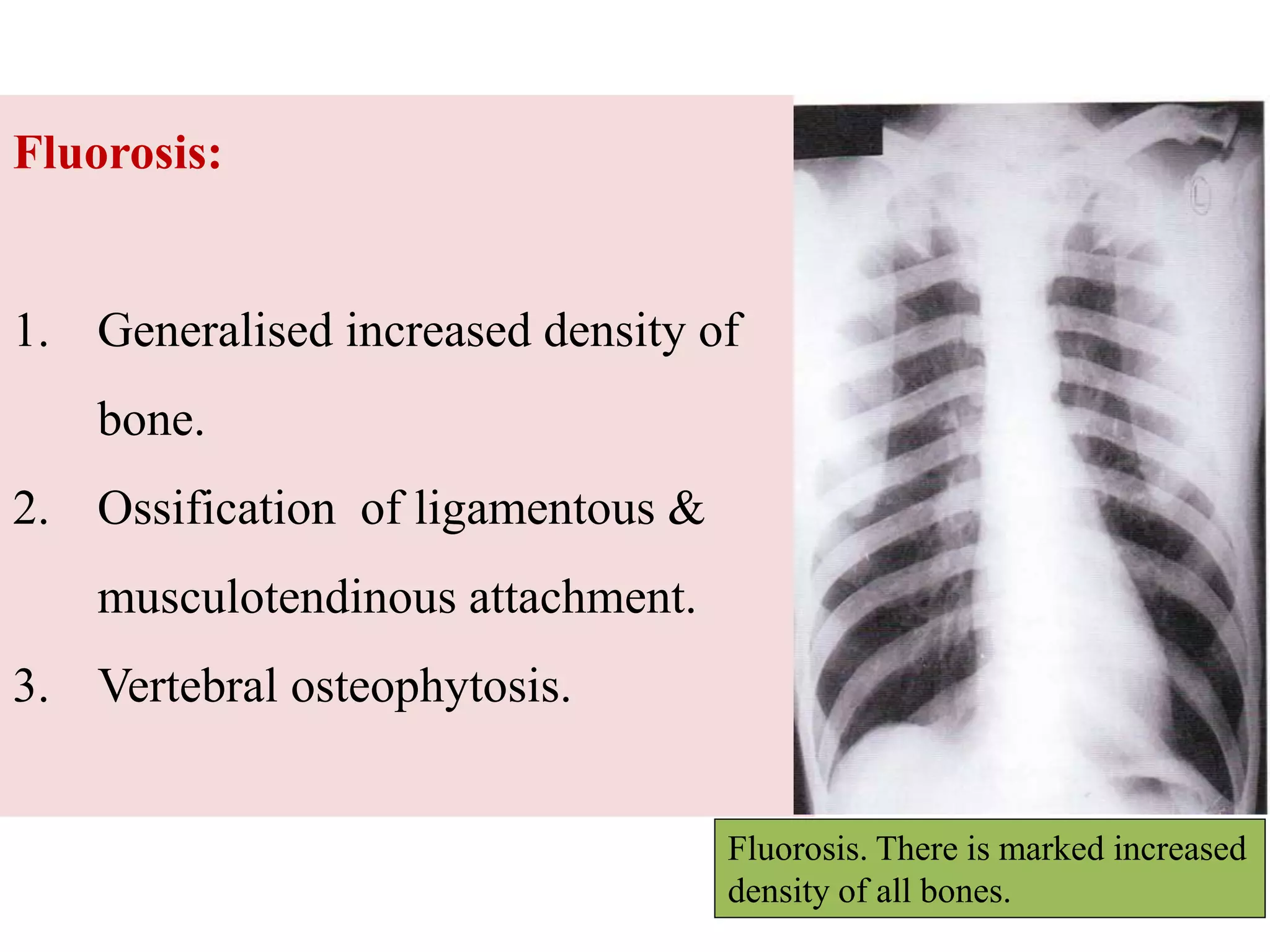 Fluorosis:
1. Generalised increased density of
bone.
2. Ossification of ligamentous &
musculotendinous attachment.
3. Vertebral osteophytosis.
Fluorosis. There is marked increased
density of all bones.
 