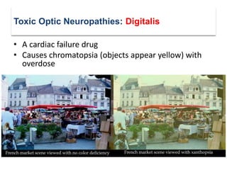 Metabolic optic neuropathies | PDF