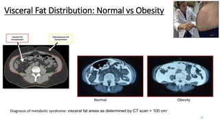 Normal Obesity
Visceral Fat Distribution: Normal vs Obesity
Diagnosis of metabolic syndrome- visceral fat areas as determined by CT scan > 100 cm2
12
 