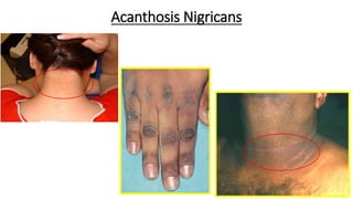 Acanthosis Nigricans
23
 