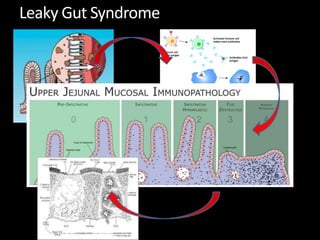 Leaky Gut Syndrome
 