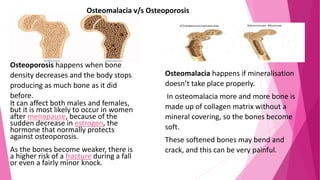 Osteomalacia v/s Osteoporosis
Osteomalacia happens if mineralisation
doesn’t take place properly.
In osteomalacia more and more bone is
made up of collagen matrix without a
mineral covering, so the bones become
soft.
These softened bones may bend and
crack, and this can be very painful.
Osteoporosis happens when bone
density decreases and the body stops
producing as much bone as it did
before.
It can affect both males and females,
but it is most likely to occur in women
after menopause, because of the
sudden decrease in estrogen, the
hormone that normally protects
against osteoporosis.
As the bones become weaker, there is
a higher risk of a fracture during a fall
or even a fairly minor knock.
 