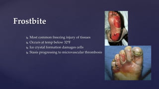 Most common freezing injury of tissues
 Occurs at temp below 32ºF
 Ice crystal formation damages cells
 Stasis progressing to microvascular thrombosis
Frostbite
 