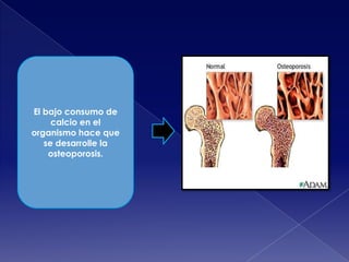 El bajo consumo de
calcio en el
organismo hace que
se desarrolle la
osteoporosis.

 