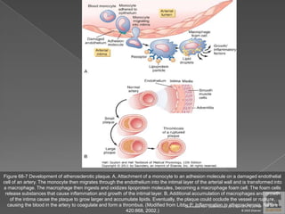 Figure 68-7 Development of atherosclerotic plaque. A, Attachment of a monocyte to an adhesion molecule on a damaged endothelial
cell of an artery. The monocyte then migrates through the endothelium into the intimal layer of the arterial wall and is transformed into
a macrophage. The macrophage then ingests and oxidizes lipoprotein molecules, becoming a macrophage foam cell. The foam cells
release substances that cause inflammation and growth of the intimal layer. B, Additional accumulation of macrophages and growth
of the intima cause the plaque to grow larger and accumulate lipids. Eventually, the plaque could occlude the vessel or rupture,
causing the blood in the artery to coagulate and form a thrombus. (Modified from Libby P: Inflammation in atherosclerosis. Nature
420:868, 2002.)
Downloaded from: StudentConsult (on 9 April 2012 10:25 PM)
© 2005 Elsevier
 