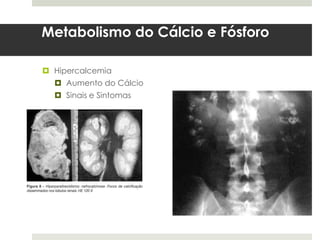 Metabolismo do Cálcio e Fósforo

 Hipercalcemia
   Aumento do Cálcio
   Sinais e Sintomas
 