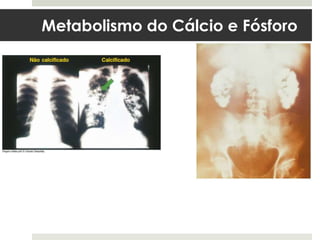 Metabolismo do Cálcio e Fósforo
 