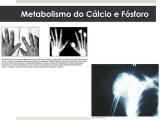 Metabolismo do Cálcio e Fósforo
 
