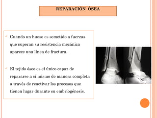  Cuando un hueso es sometido a fuerzas
que superan su resistencia mecánica
aparece una línea de fractura.
 El tejido óseo es el único capaz de
repararse a sí mismo de manera completa
a través de reactivar los procesos que
tienen lugar durante su embriogénesis.
REPARACIÓN ÓSEA
 