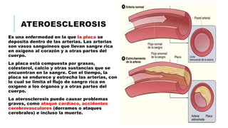 ATEROESCLEROSIS
Es una enfermedad en la que la placa se
deposita dentro de las arterias. Las arterias
son vasos sanguíneos que llevan sangre rica
en oxígeno al corazón y a otras partes del
cuerpo.
La placa está compuesta por grasas,
colesterol, calcio y otras sustancias que se
encuentran en la sangre. Con el tiempo, la
placa se endurece y estrecha las arterias, con
lo cual se limita el flujo de sangre rica en
oxígeno a los órganos y a otras partes del
cuerpo.
La aterosclerosis puede causar problemas
graves, como ataque cardíaco, accidentes
cerebrovasculares (derrames o ataques
cerebrales) e incluso la muerte.
 