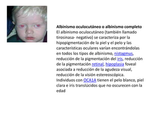 Albinismo oculocutáneo o albinismo completo
El albinismo oculocutáneo (también llamado
tirosinasa- negativo) se caracteriza por la
hipopigmentación de la piel y el pelo y las
características oculares varían encontrándolas
en todos los tipos de albinismo, nistagmus,
reducción de la pigmentación del iris, reducción
de la pigmentación retinal, hipoplasia foveal
asociada a reducción de la agudeza visual,
reducción de la visión estereoscópica.
Individuos con OCA1A tienen el pelo blanco, piel
clara e iris translúcidos que no oscurecen con la
edad
 