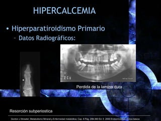 HIPERCALCEMIA
• Hiperparatiroidismo Primario
– Datos Radiográficos:
Resorción subperiostica
Perdida de la lamina dura
Gord...