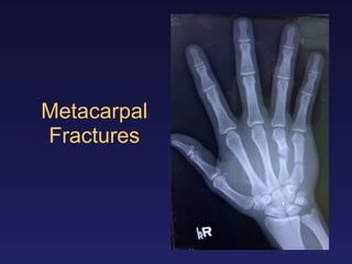Metacarpal
Fractures
 
