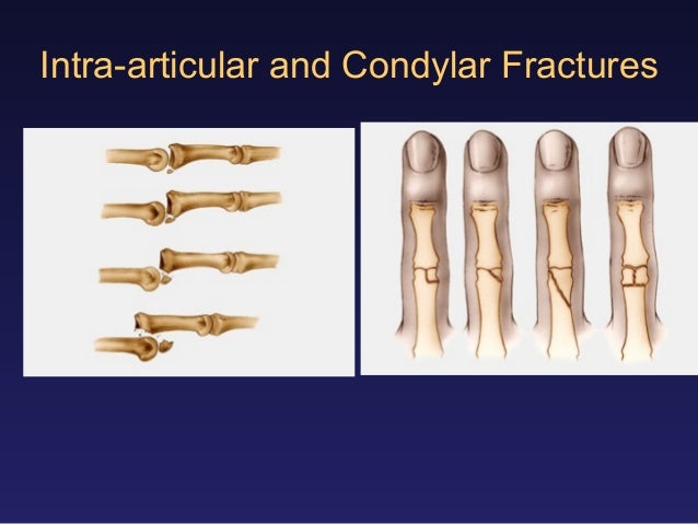Metacarpal fractures