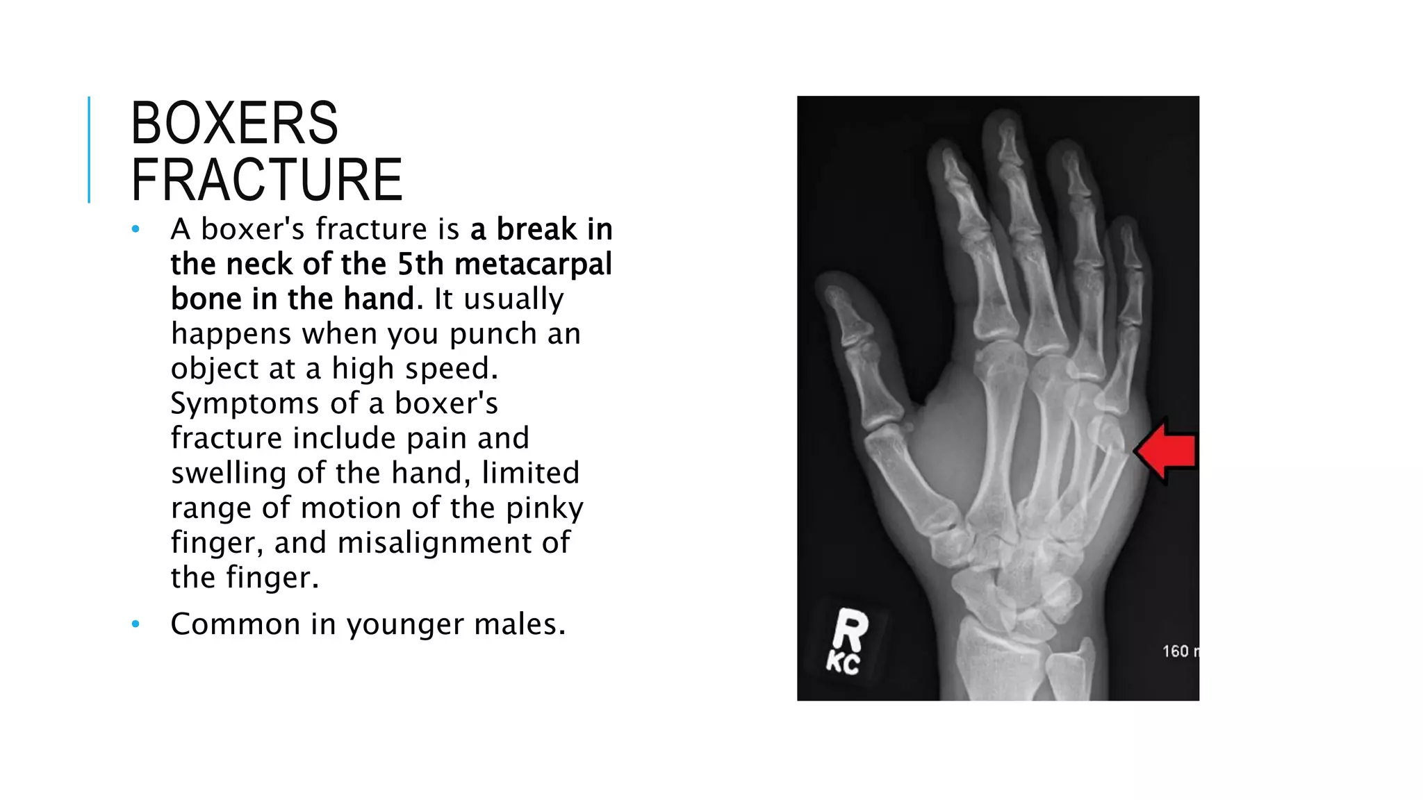 metacarpals & phalanges fractures.pptx
