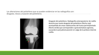 Las alteraciones del polietileno que se pueden evidenciar en las radiografías son:
desgaste, rotura y luxación del polietileno.
Desgaste del polietileno. Radiografía anteroposterior de rodilla
derecha que revela desgaste del polietileno (flecha roja)
acompañado de areas radiolucentes del hueso periimplantado
(flecha verde) que corresponden a granulomatosis agresiva,
causando la perjudicial posición en valgo de la prótesis total de
rodilla.
 