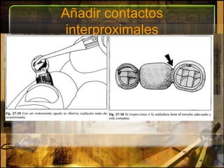 Añadir contactos interproximales