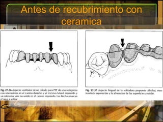 Antes de recubrimiento con ceramica