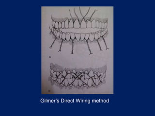 Gilmer’s Direct Wiring method
 