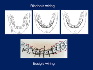 Risdon’s wiring
Essig’s wiring
 