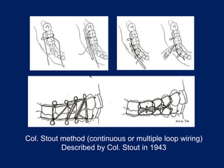 Col. Stout method (continuous or multiple loop wiring)
Described by Col. Stout in 1943
 