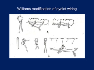 Williams modification of eyelet wiring
 