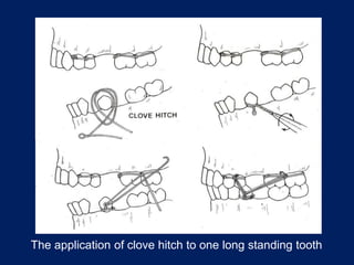 The application of clove hitch to one long standing tooth
 