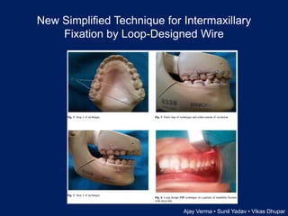 New Simplified Technique for Intermaxillary
Fixation by Loop-Designed Wire
Ajay Verma • Sunil Yadav • Vikas Dhupar
 