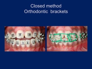 Closed method
Orthodontic brackets
 