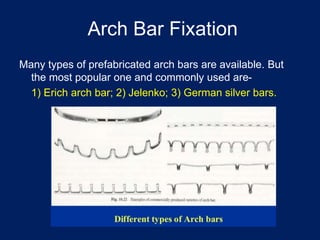 Arch Bar Fixation
Many types of prefabricated arch bars are available. But
the most popular one and commonly used are-
1) Erich arch bar; 2) Jelenko; 3) German silver bars.
 