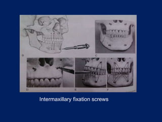 Intermaxillary fixation screws
 