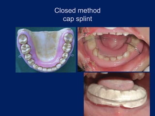 Closed method
cap splint
 
