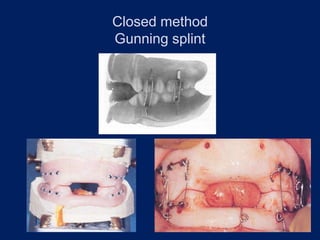 Closed method
Gunning splint
 