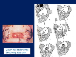 Circum-mandibular wiring
of Gunning- type splint
 